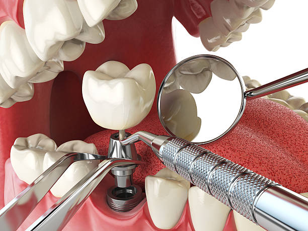 Best Emergency Dental Care for Broken or Chipped Teeth in Morrisville, NY